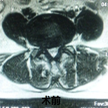 右下肢疼痛麻木3个半月