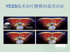 如何正确选择 YESS 技术与 TESSYS 技术 椎间孔镜